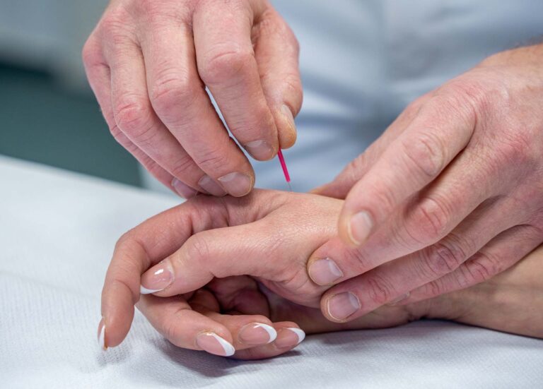 Akupunktur